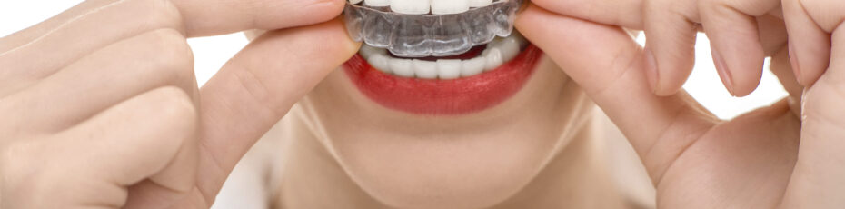 tips to read before getting invisalign