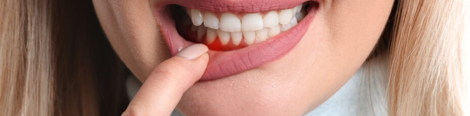 identifying the various stages of gum disease