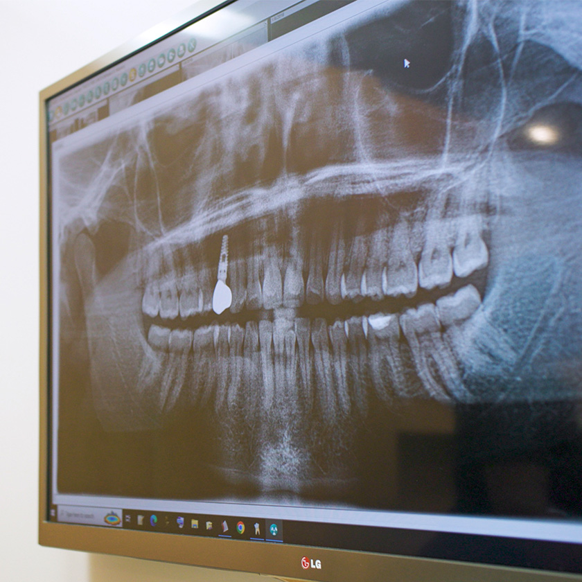 Intraoral Digital X Rays Dentist Near Me