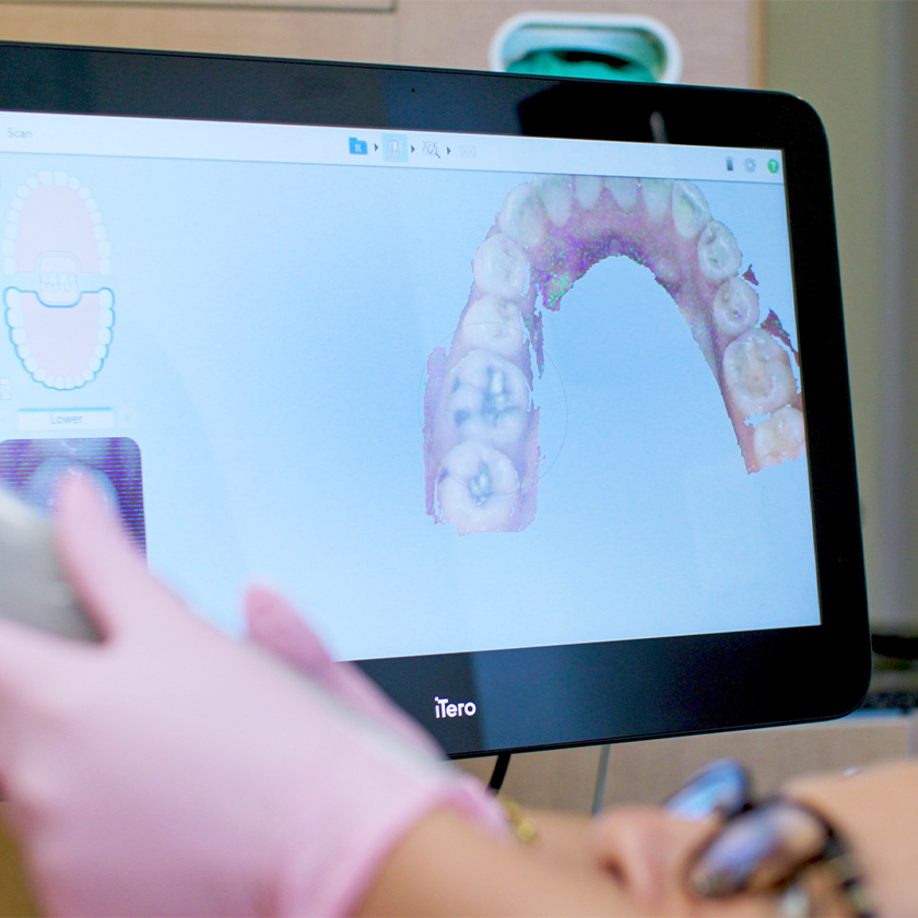 Itero Digital Scanner Dentists In Cooper City Fl